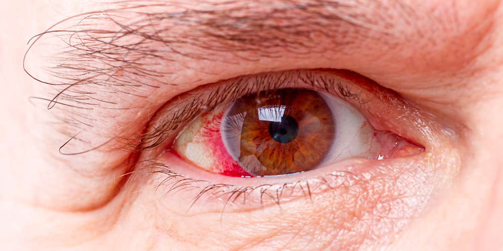 red-eyes